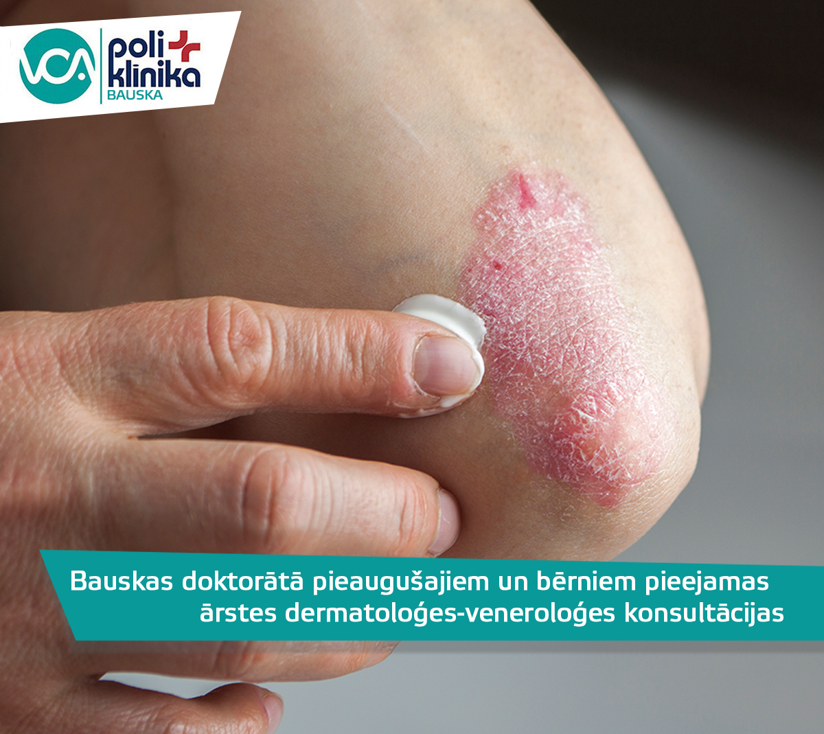 Bauskas doktorātā pieaugušajiem un bērniem pieejamas  ārstes dermatoloģes-veneroloģes kons